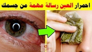 صورة احمرار العين | ماذا يعني احمرار الجزء الأبيض من العين عند استيقاظك من النوم؟