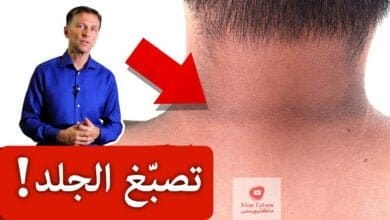 صورة تصبغات الجلد | الحل لتصبغات الجلد في الرقبة وتحت الابط وأماكن أخرى!