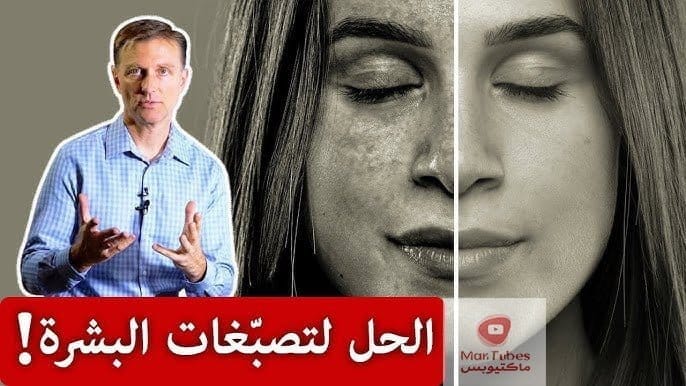 تصبغات الوجه | وصفة فعالة للتخلص من تصبغات الوجه وتحت العينين