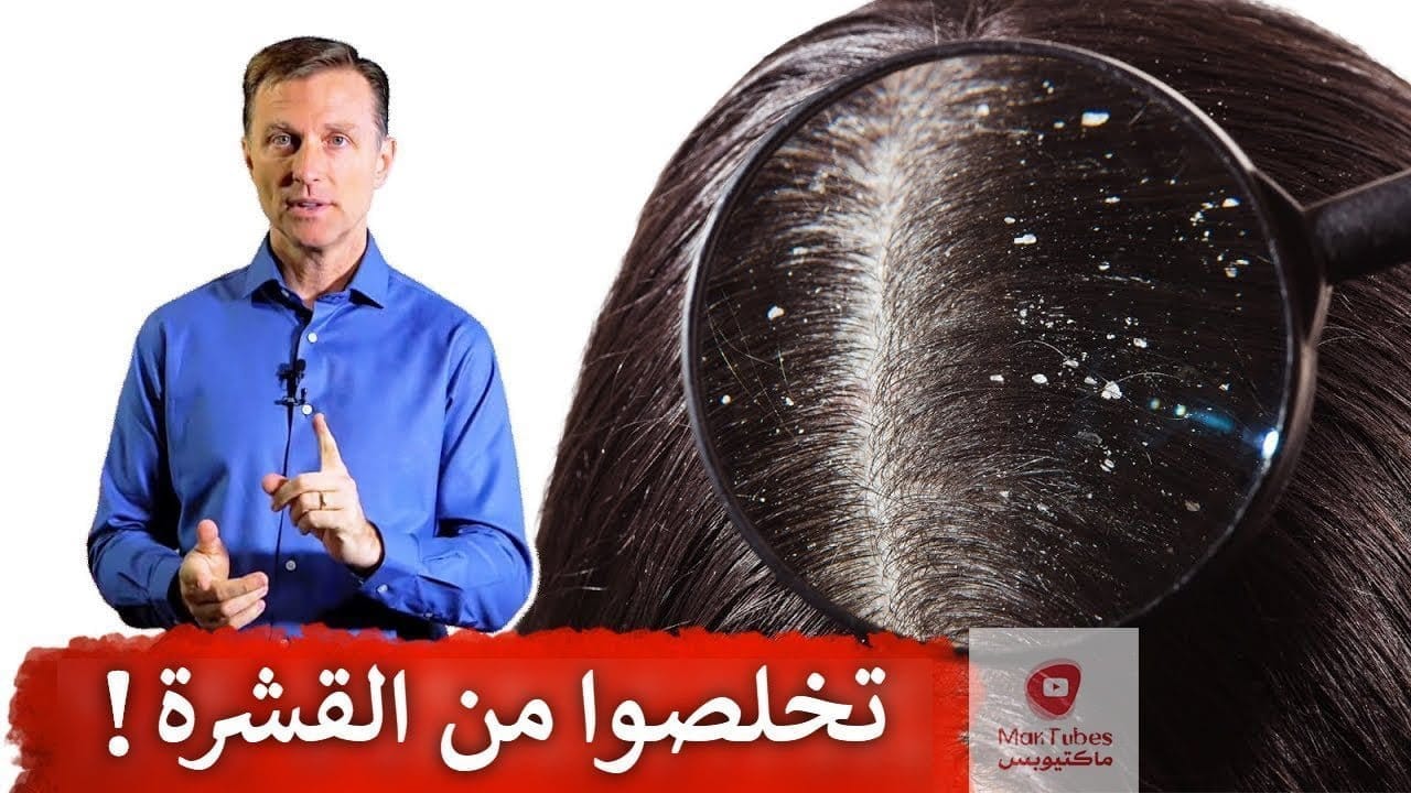 قشرة الرأس | كيف تظهر ؟ وكيف نتخلص من القشرة دون رجعة!