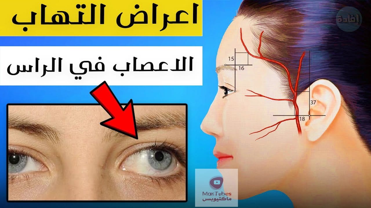 اعراض التهاب الاعصاب في الرأس | هل من الممكن ظهور مضاعغات خطيرة؟