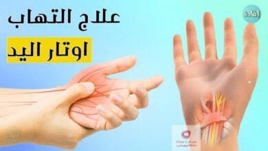 صورة التهاب اوتار اليد | ما هو افضل العلاجات؟ | متى نلجأ للعملية الجراحية؟
