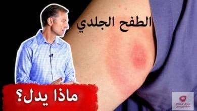 صورة الطفح الجلدي الذي يدل على داء لايم الخطير | ما هي اعراضه؟