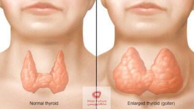 صورة تضخم الغدة الدرقية | ما هي اعراضها؟ | وكيف يتم العلاج؟