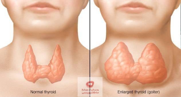 تضخم الغدة الدرقية | ما هي اعراضها؟ | وكيف يتم العلاج؟