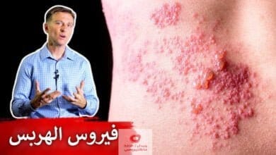 صورة الهربس | ما هو؟ | ومتى يحدث | وماذا نفعل عند الاصابة به؟