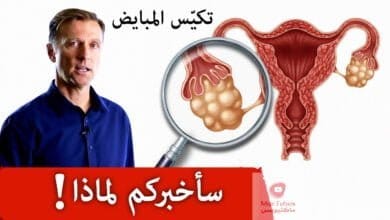 صورة تكيس المبايض | ما هي اسباب تكيس المبايض وهل يمكن علاجها ؟