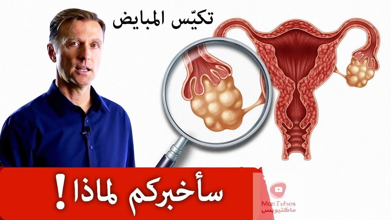تكيس المبايض | ما هي اسباب تكيس المبايض وهل يمكن علاجها ؟