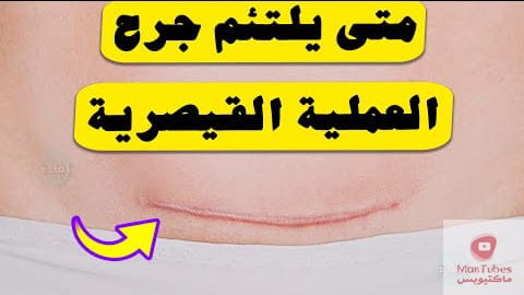 جرح العملية القيصرية | متى يلتئم | وما هي النصائح المتبعة لتعزيز ألتئام الجرح؟