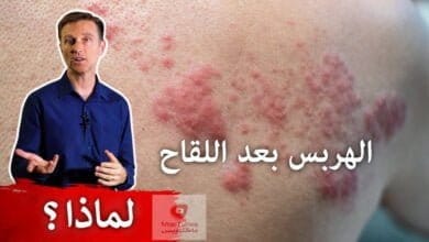 صورة تطعيم لفيروس الكورونا | لماذا يصاب البعض بالهربس بعد تلقي التطعيم؟