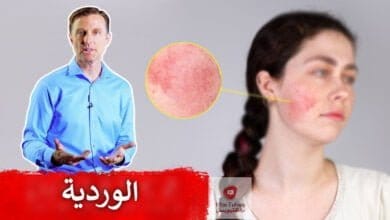صورة اسباب احمرار الوجه والعد الوردي | ما هو العلاج الطبيعي لهما؟