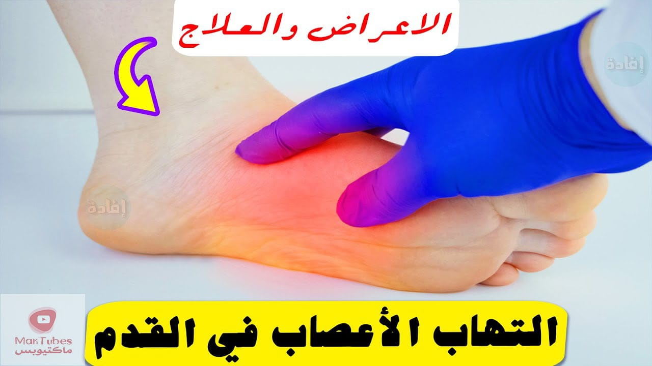 التهاب الاعصاب في القدم | ما هي الاعراض ؟ | ما هو العلاج ؟