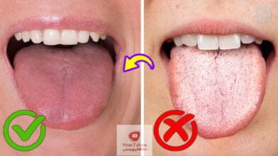 صورة اسباب بياض اللسان | اسباب رائحة الفم | وما هو العلاج المناسب لهما؟