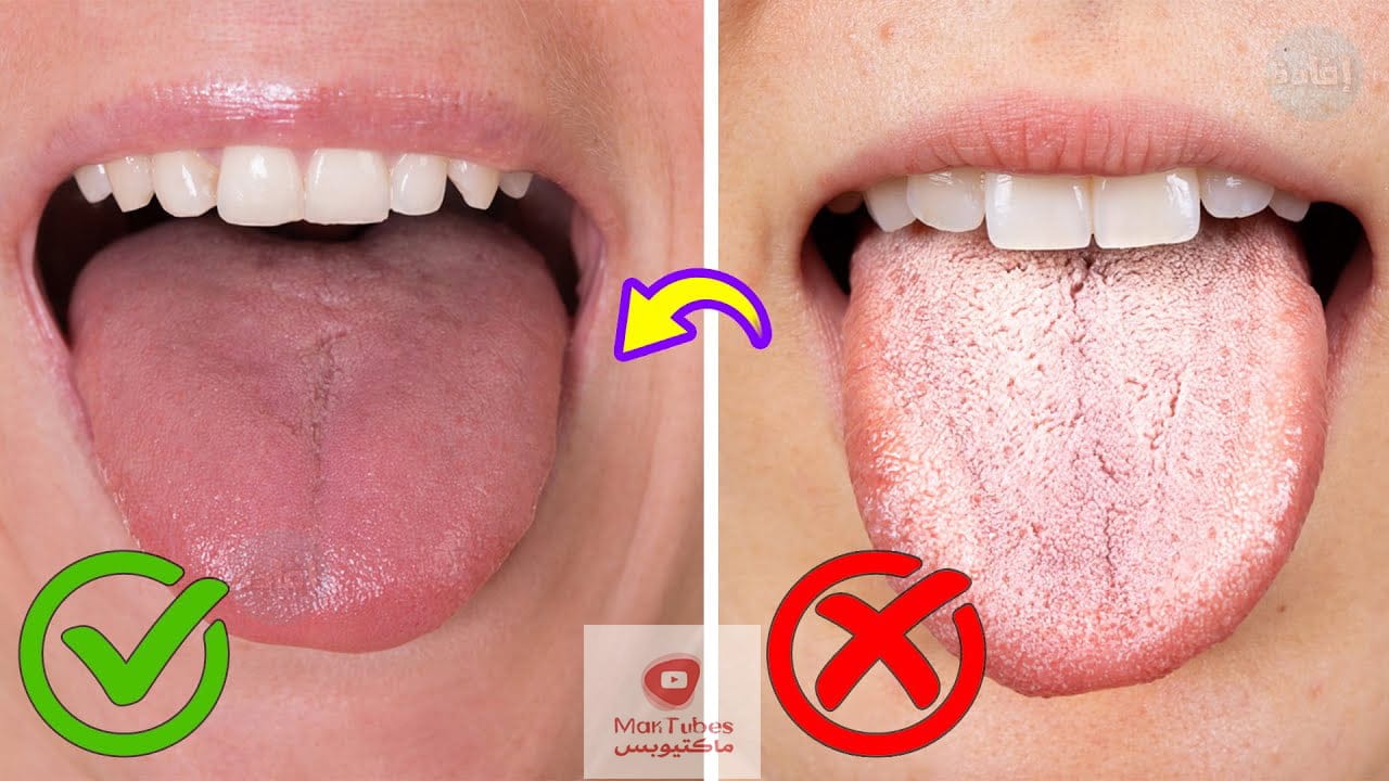اسباب بياض اللسان | اسباب رائحة الفم | وما هو العلاج المناسب لهما؟