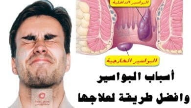 صورة علاج البواسير | ماهي اسبابها | وما هي افضل طريقة لعلاج البواسير في المنزل