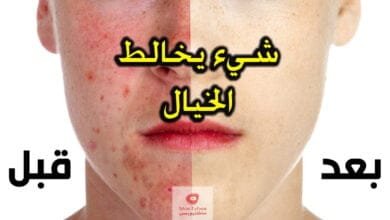 صورة استعمالات الاسبرين | اهم 8 استعمالات منها للبشرة والملابس