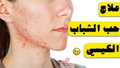 صورة علاج حب الشباب الكيسي طبيعياً | وما هي اسباب ظهوره؟