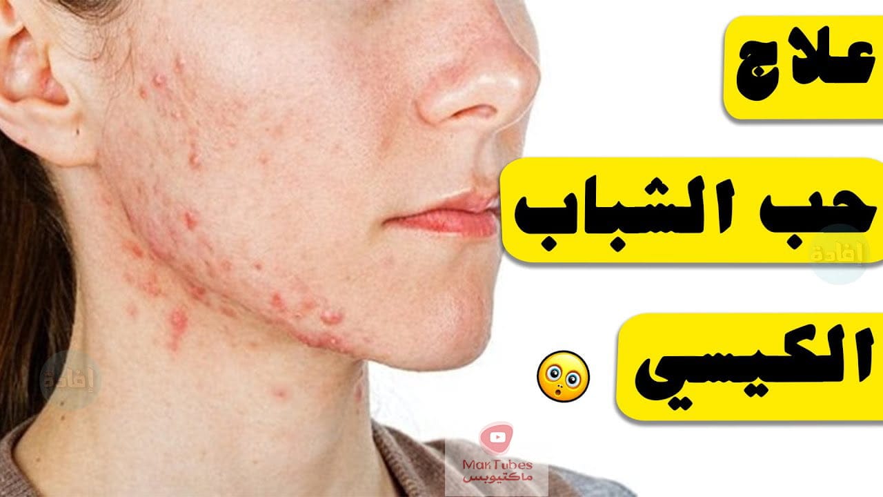 علاج حب الشباب الكيسي طبيعياً | وما هي اسباب ظهوره؟