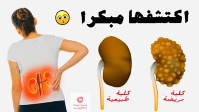 صورة علامات الفشل الكلوي | 10 علامات قد تسبب “الفشل الكلوي” الخطير