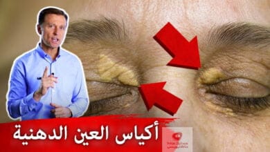 صورة بقع حول العين وأكياس | ما هي أسبابها وكيف يمكن علاجها!