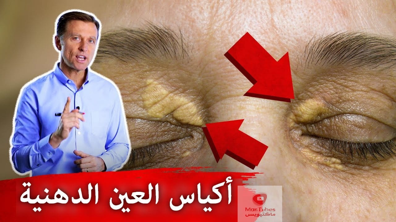بقع حول العين وأكياس | ما هي أسبابها وكيف يمكن علاجها!