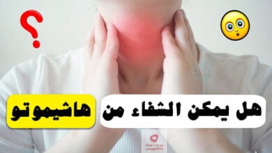 صورة مرض هاشيموتو | هل يمكن الشفاء منه؟ وهل الضغط العصبي يؤثر بذلك؟