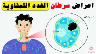صورة اعراض سرطان الغدد اللمفاوية | ومتى يجب مراجعة الطبيب؟