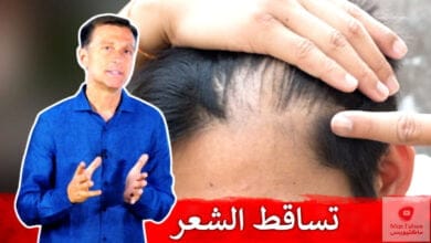 صورة خلل الهرمونات | تساقط الشعر | ستة أسباب ناتجة عن خلل الهرمونات