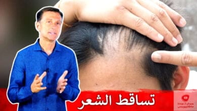 صورة تساقط الشعر لدى النساء | ما هي الاسباب وما هو العلاج المناسب؟