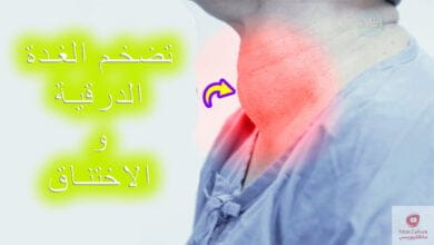 صورة هل تضخم الغدة الدرقية يسبب الاختناق؟ وما هو العلاج المناسب؟