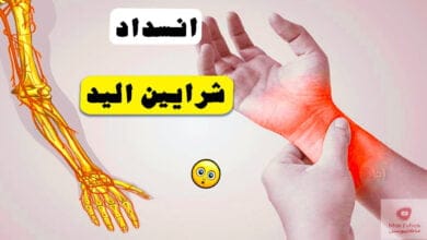 صورة اعراض انسداد شرايين اليد | وما هي الاجراءات الوقائية والعلاجية؟