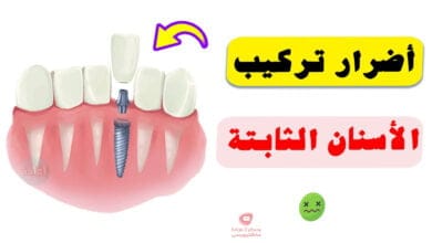 صورة أضرار تركيب الأسنان الثابتة | وما هي اضرارها على المدى البعيد؟