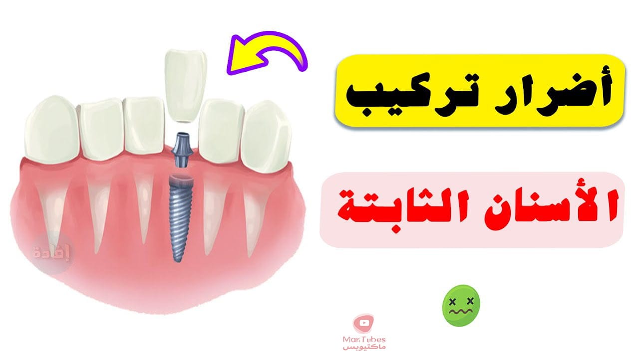 أضرار تركيب الأسنان الثابتة | وما هي اضرارها على المدى البعيد؟