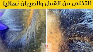 صورة علاج القمل | طريقة التخلص من القمل والصيبان في يوم واحد نهائيا