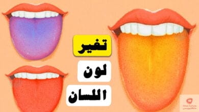 صورة اسباب تغير لون اللسان؟ وهل يعني انك مصاب بمرض معين؟