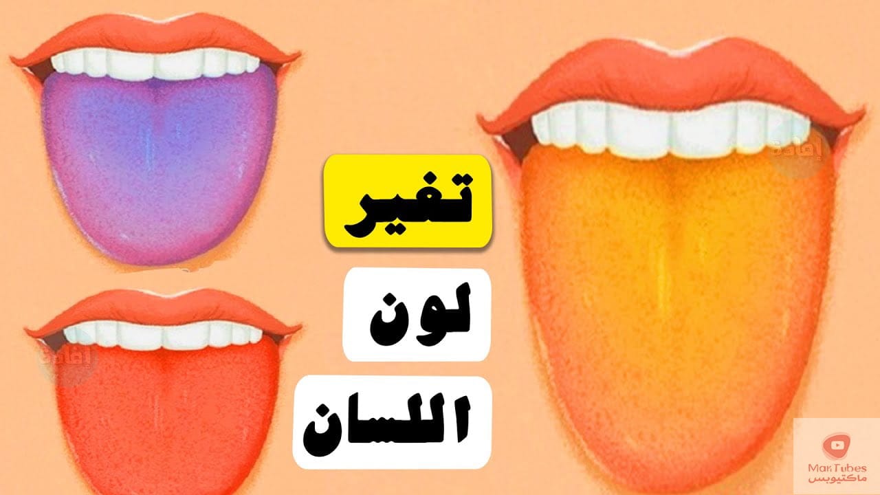 اسباب تغير لون اللسان؟ وهل يعني انك مصاب بمرض معين؟