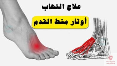 صورة التهاب أوتار مشط القدم | ما هي اهم طرق والنصائح للعلاج؟