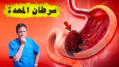 صورة أعراض سرطان المعدة التي لابد ان تعرفها
