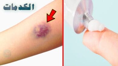 صورة علاج الكدمات الزرقاء – افضل مرهم لعلاجها، وطرق علاجها في المنزل
