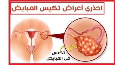 صورة تكيسات المبايض – اهم 5 اعراض تكيسات المبايض