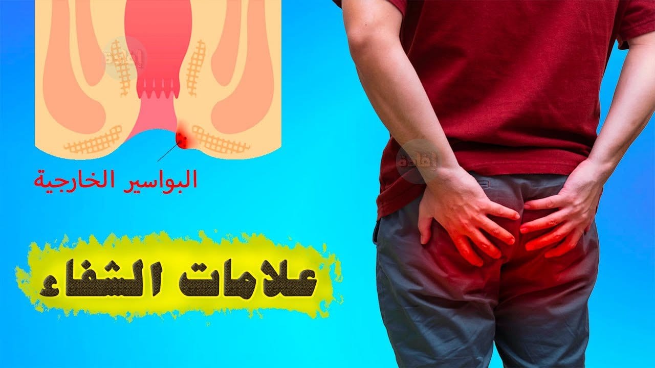 البواسير الخارجية - ما هي علامات الشفاء منها؟